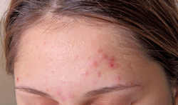 Pimples on forehead