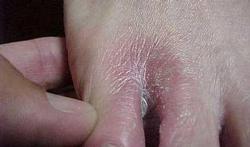 foot candida